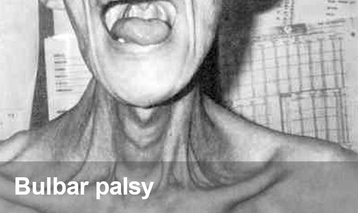 Neurological Diseases - Bulbar Palsy - Elabscience